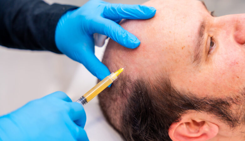 Implantes Capilares en Medellín – Recupera tu Confianza con CapilTech