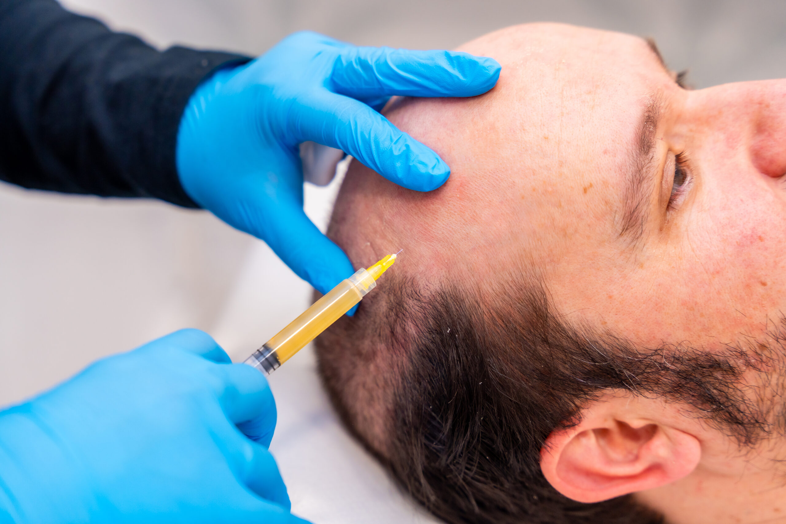 Implantes Capilares en Medellín – Recupera tu Confianza con CapilTech