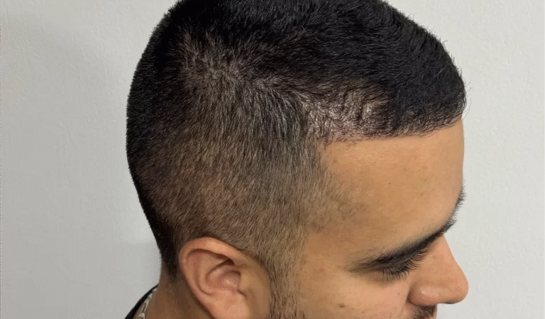 ¿Cuánto cuesta una prótesis capilar? Guía completa de precios 2025 – Capiltech