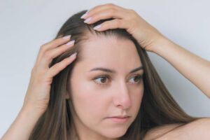 alopecia femenina en medellín