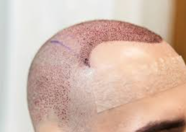 Injerto Capilar en Medellín: Tu Guía Definitiva para Recuperar el Cabello y la Confianza