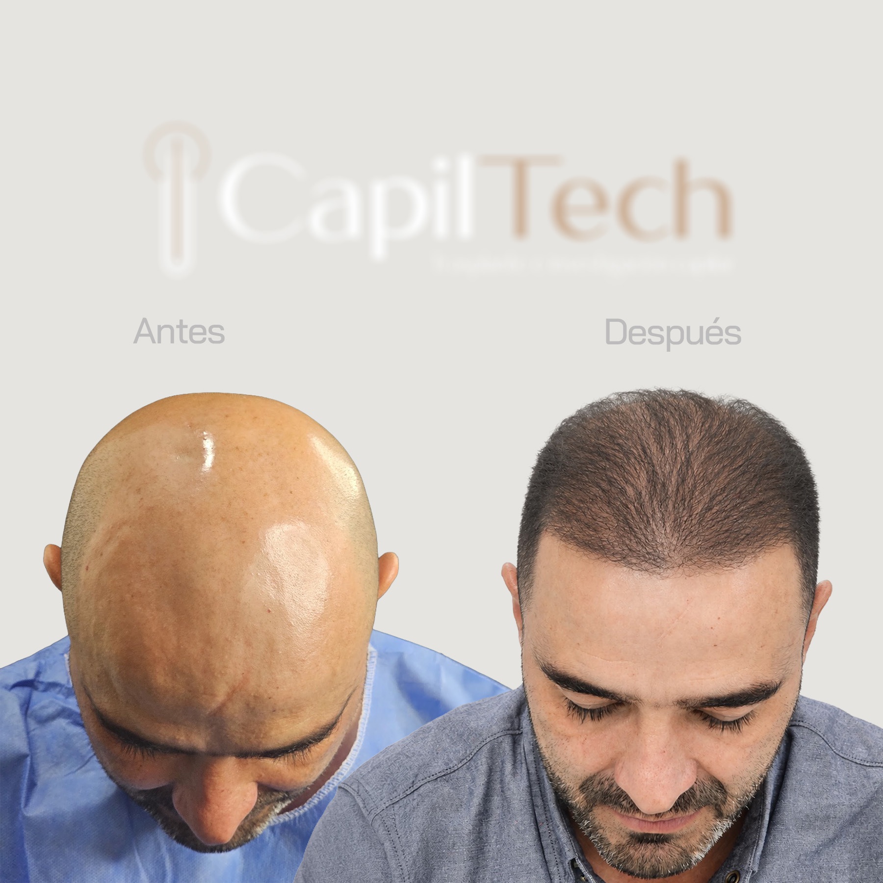 Resultado antes y después de injerto capilar CapilTech